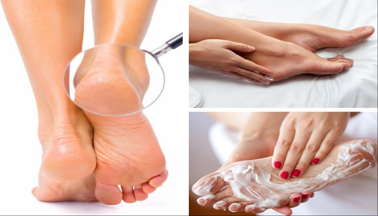 ¿Talones ásperos y agrietados? 4 remedios naturales para recuperar su suavidad