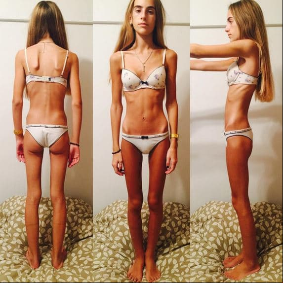 Tuvo anorexia a los 13 y su relato se volvió viral: «Mi cuerpo me pedía a gritos que pare»