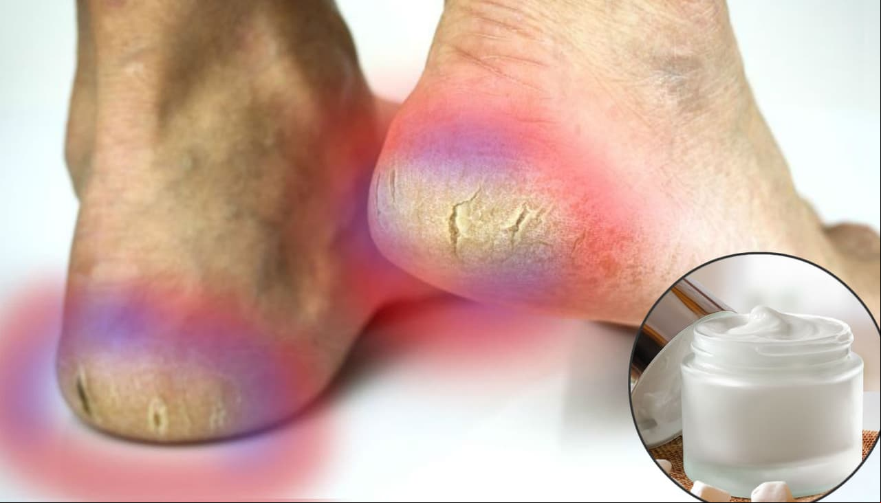 Talones agrietados: dermatóloga enseña a preparar una potente crema para combatirlos